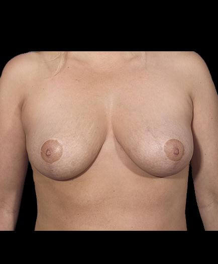 Breast Reduction After Image