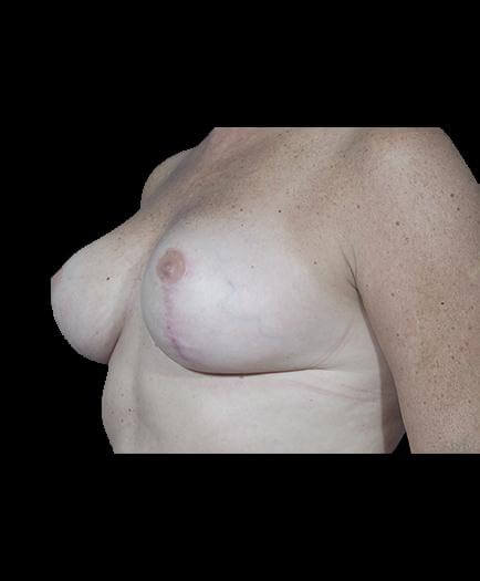 Reduction Mammoplasty After Image