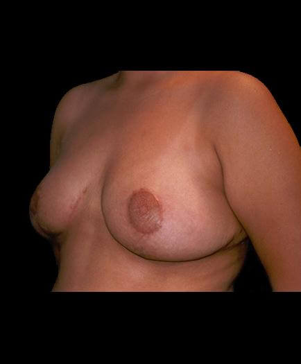 Virginia Reduction Mammoplasty After Image