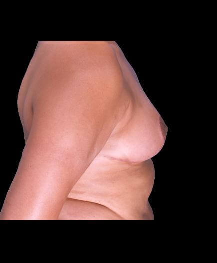 Reduction Mammoplasty Surgery After Image