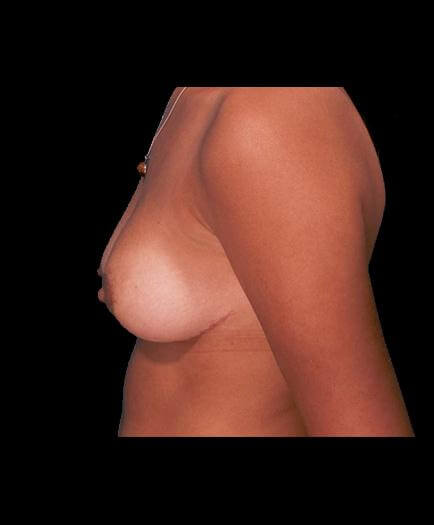 Virginia Reduction Mammoplasty Surgery After Image