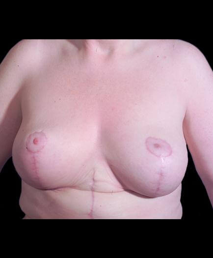 After Breast Lift