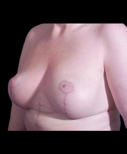 After Breast Lift Surgery