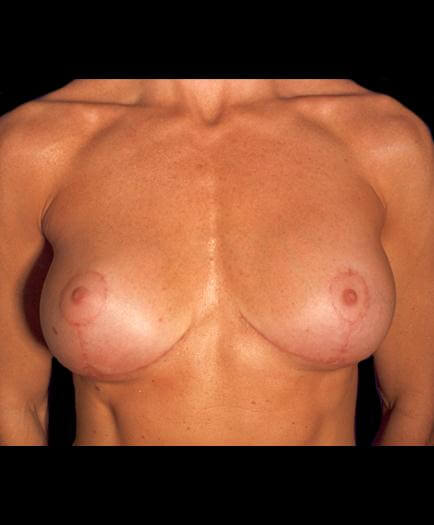 Breast Lift Surgery After