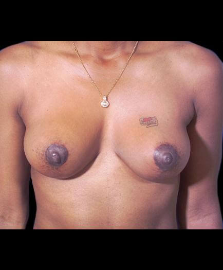 Breast Lift After Image