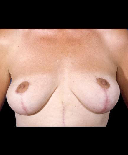 Breast Lift Surgery After Picture