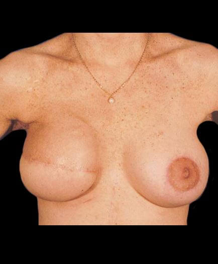 After Breast Reconstruction