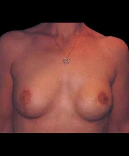 Breast Reconstruction After Photo