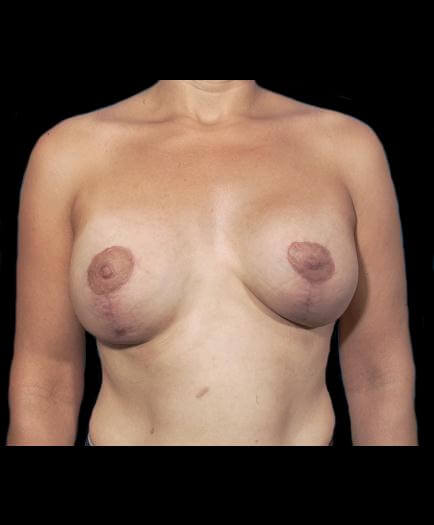 Breast Asymmetry Front View After