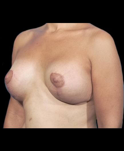 Breast Asymmetry Quarter View After