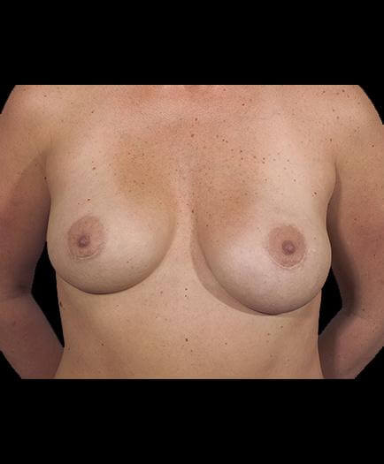 Asymmetrical Breast Correction Front View After