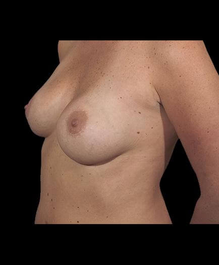 Asymmetrical Breast Correction Quarter View After