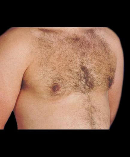 Gynecomastia Before