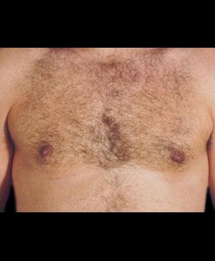 Gynecomastia Surgery After