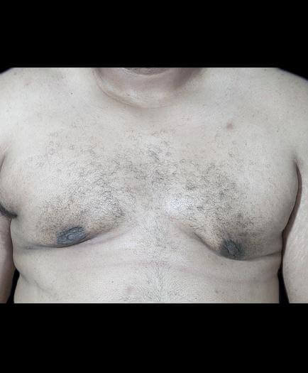 Male Breast Reduction Surgery After