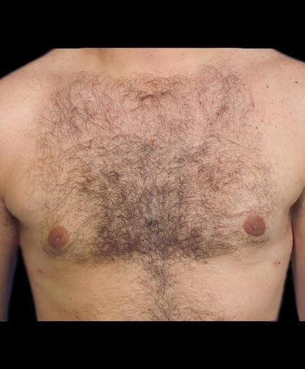 After Male Breast Reduction