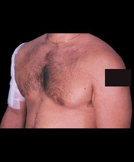After Male Breast Reduction Surgery