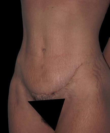 Tummy Tuck After