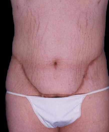 Tummy Tuck Procedure After