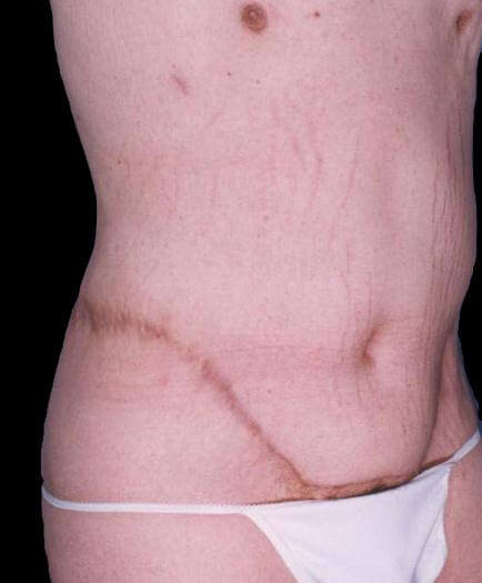 Tummy Tuck Treatment After