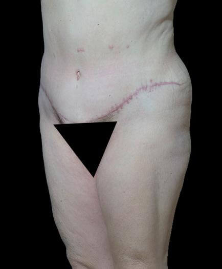 Abdominoplasty After