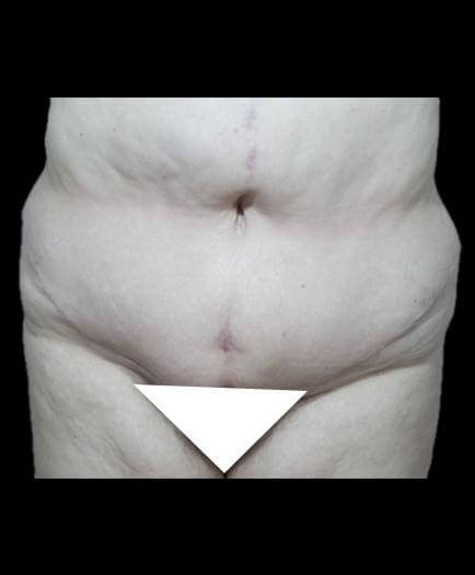 Abdominoplasty Surgery After