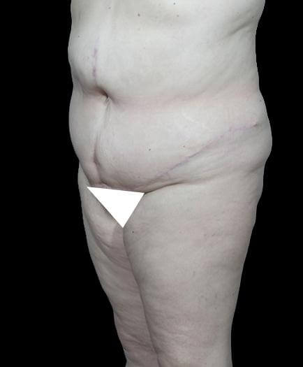 Abdominoplasty Surgery Quarter View After