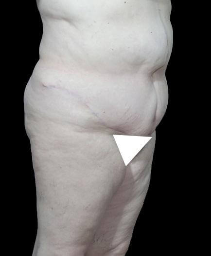 Abdominoplasty Procedure After