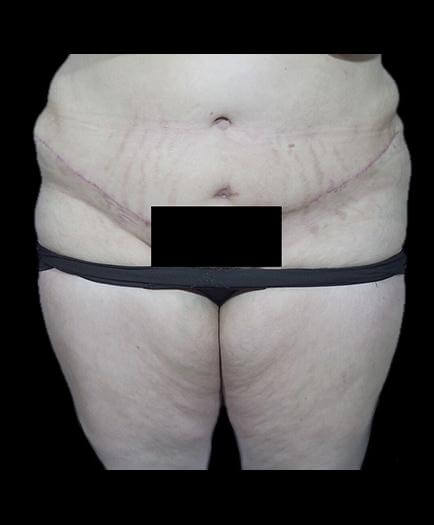 Tummy Tuck & Lipo Front View After