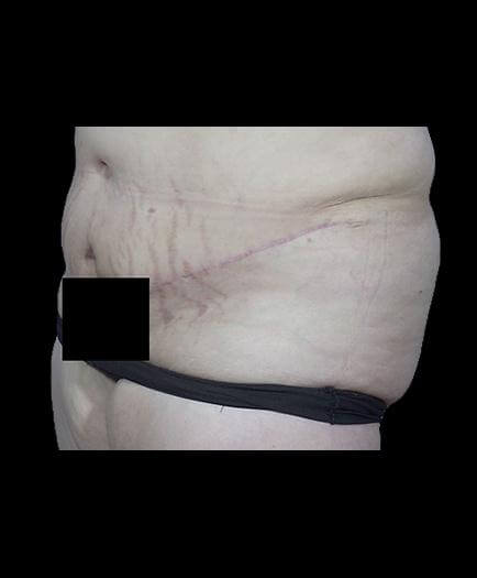 Tummy Tuck & Lipo After