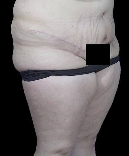 Tummy Tuck & Lipo Quarter View After