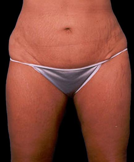 Female Tummy Tuck After