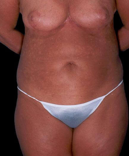 Tummy Tuck For Women After