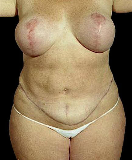 Women’s Tummy Tuck Front View After 