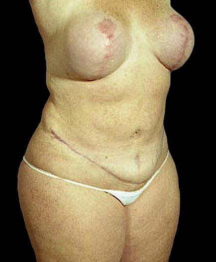 Women’s Tummy Tuck After