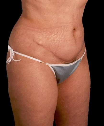 Lipo & Body Contouring After