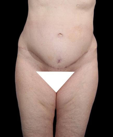 Abdominal Lipo & Tightening Front View After