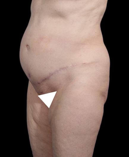 Abdominal Lipo & Tightening Quarter View After