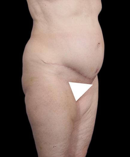 Abdominal Lipo & Tightening After