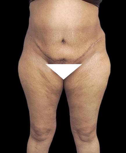 Abdominoplasty & Lipo Front View After