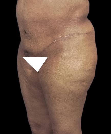 Abdominoplasty & Lipo Quarter View After