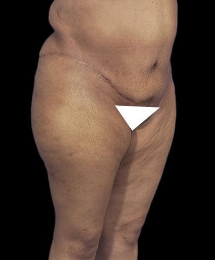 Abdominoplasty & Lipo Quarter View After