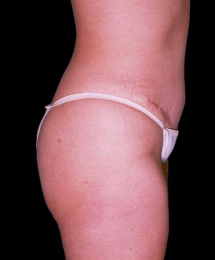 Abdominoplasty & Lipo Side View After