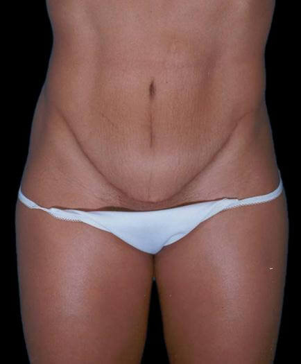 Women’s Tummy Tuck Surgery After