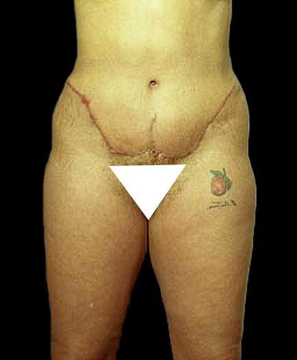 After Tummy Tuck