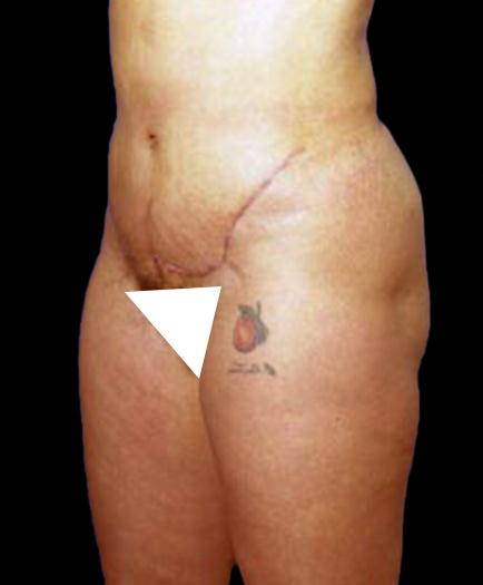 After Tummy Tuck Surgery