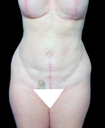 After Abdominoplasty