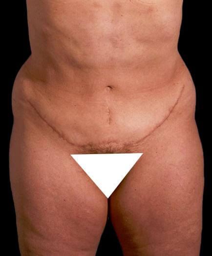 After Abdominoplasty Surgery Front View