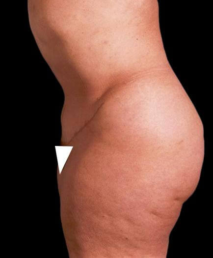 After Abdominoplasty Surgery Side View
