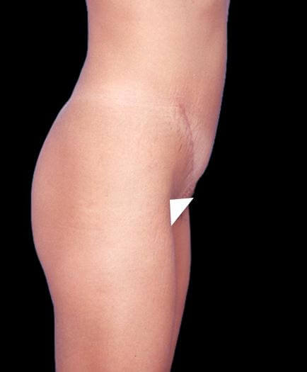 After Tummy Tuck Treatment